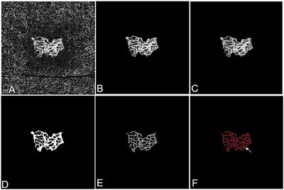 Optical Coherence Tomography Angiography-Based Quantitative Assessment of Morphologic Changes in Active Myopic Choroidal Neovascularization During Anti-vascular Endothelial Growth Factor Therapy